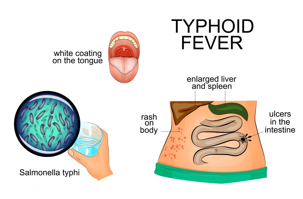 Typhoid Typhoid
